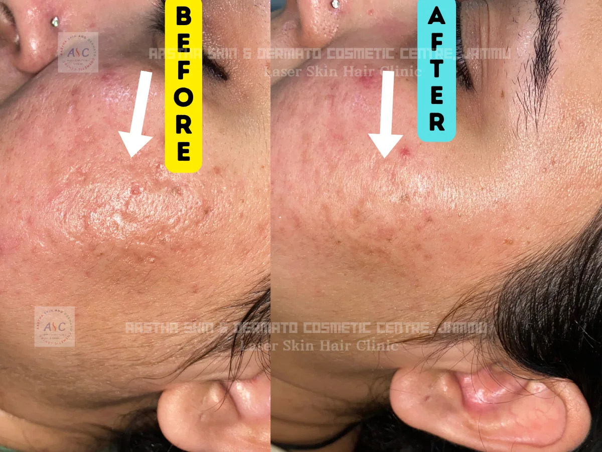 Clinic-supplied before-and-after photograph for acne-scar treatment (1 of 4).