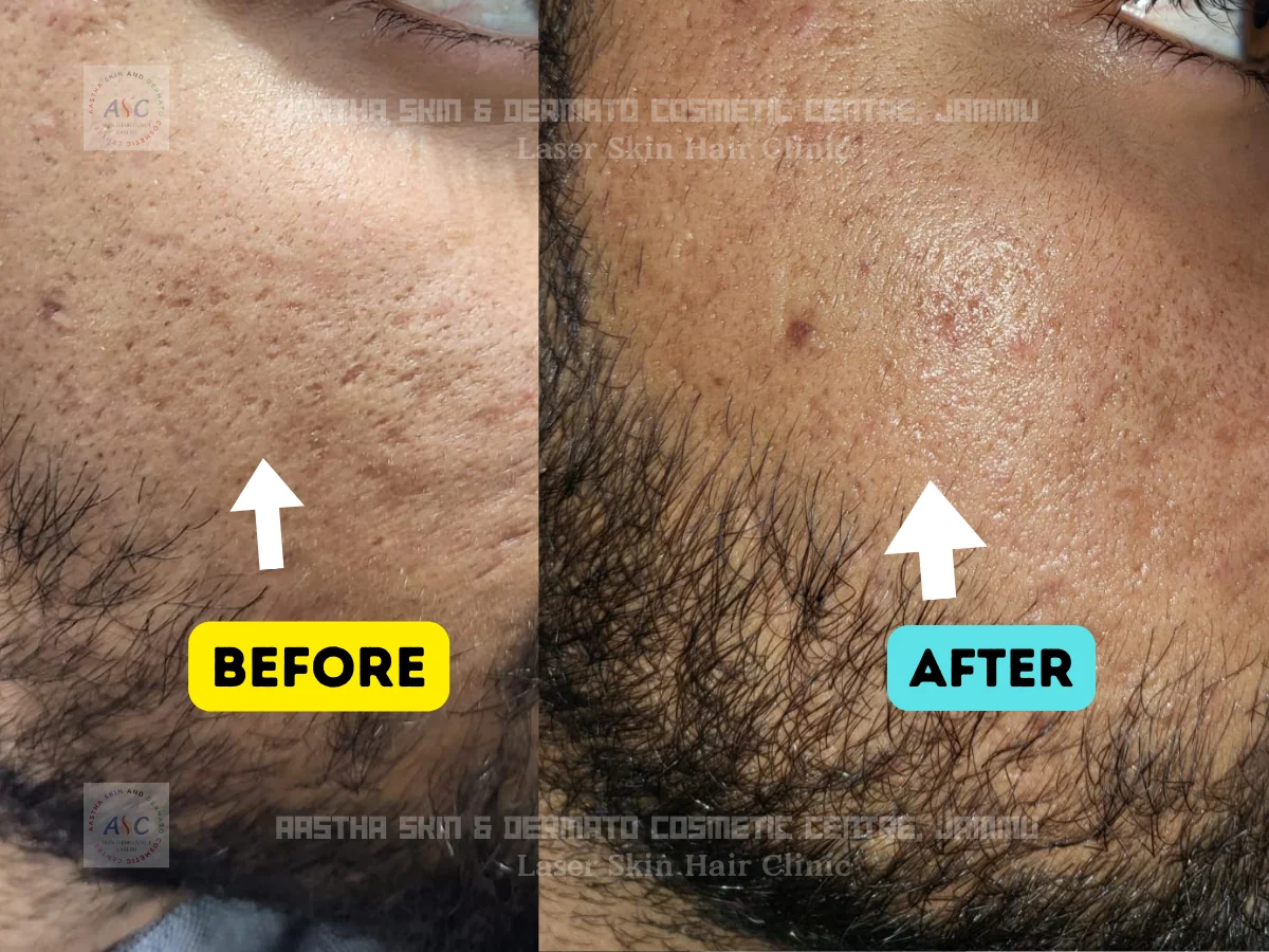 Clinic-supplied before-and-after photograph for acne-scar treatment (2 of 4).