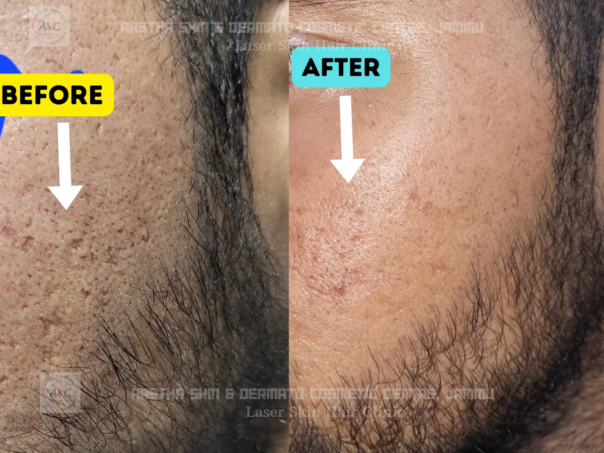 Clinic-supplied before-and-after photograph for acne-scar treatment (3 of 4).