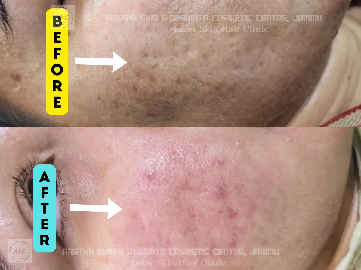 Clinic-supplied before-and-after photograph for acne-scar treatment (4 of 4).