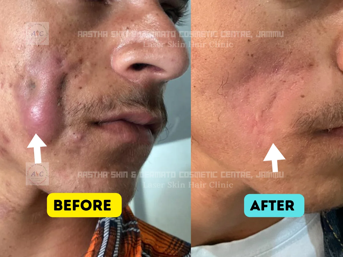 Clinic-supplied before-and-after photograph for acne treatment (1 of 1).