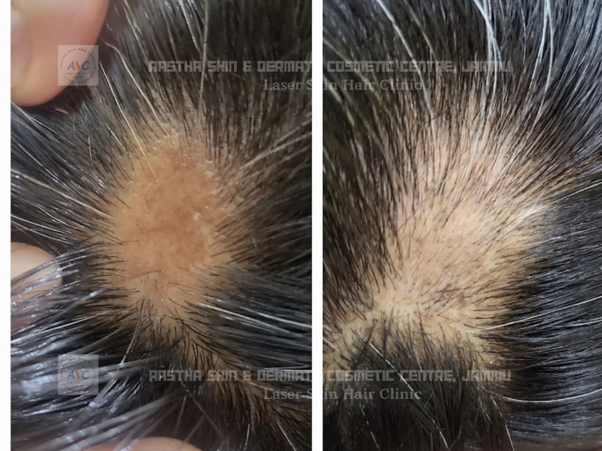 Clinic-supplied before-and-after photograph for alopecia areata treatment (1 of 1).
