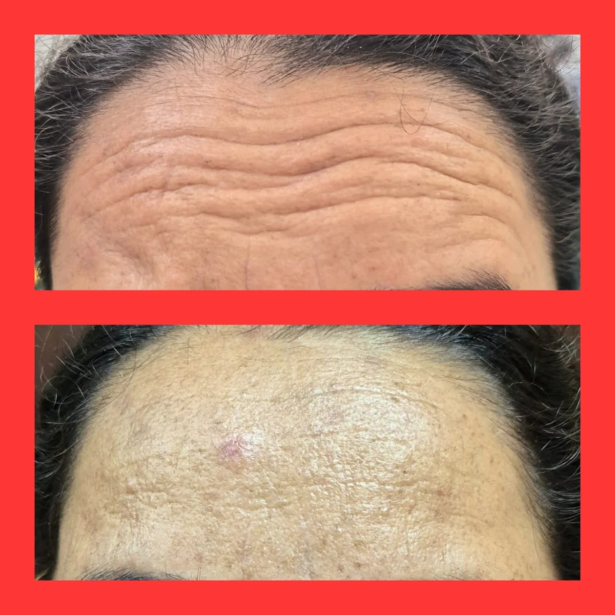 Clinic-supplied before-and-after photograph for botulinum toxin and dermal filler treatment (1 of 9).