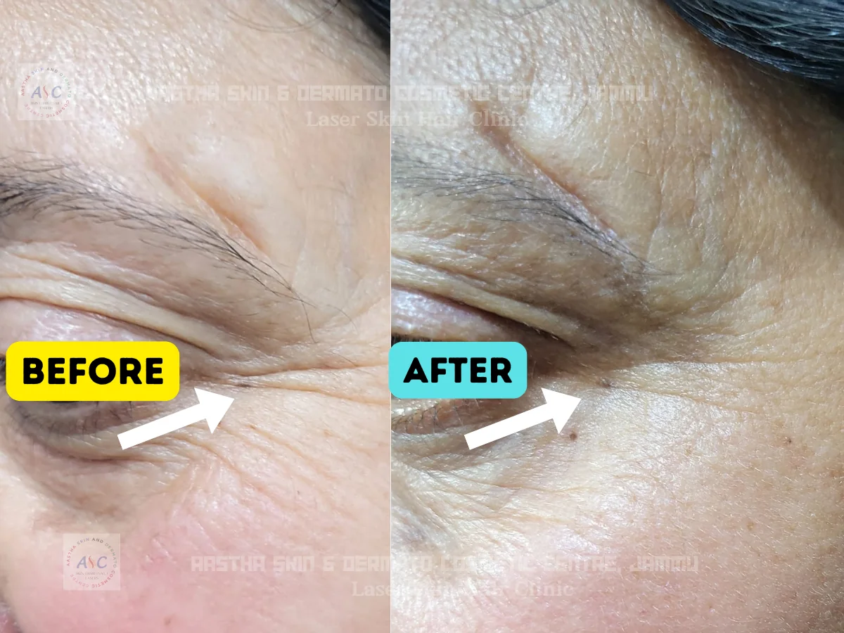 Clinic-supplied before-and-after photograph for botulinum toxin and dermal filler treatment (2 of 9).