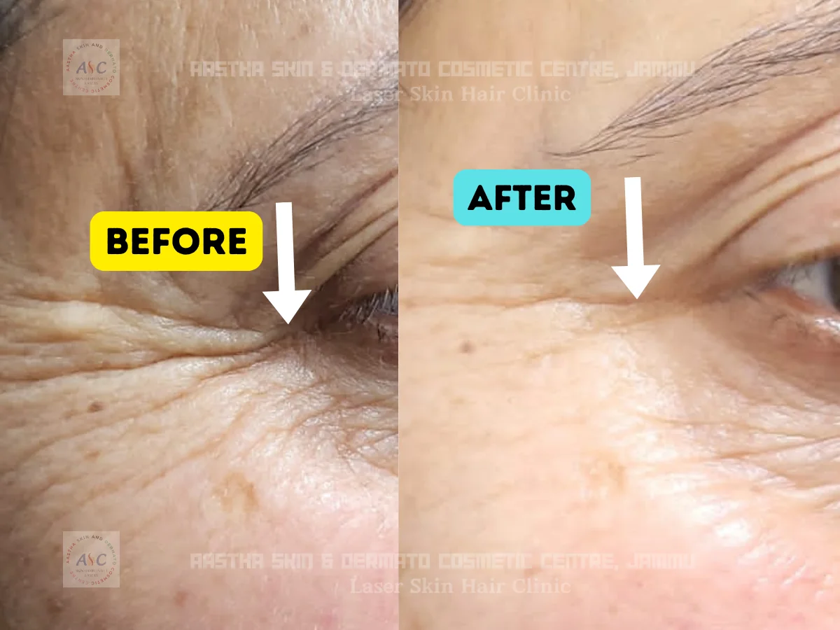 Clinic-supplied before-and-after photograph for botulinum toxin and dermal filler treatment (3 of 9).