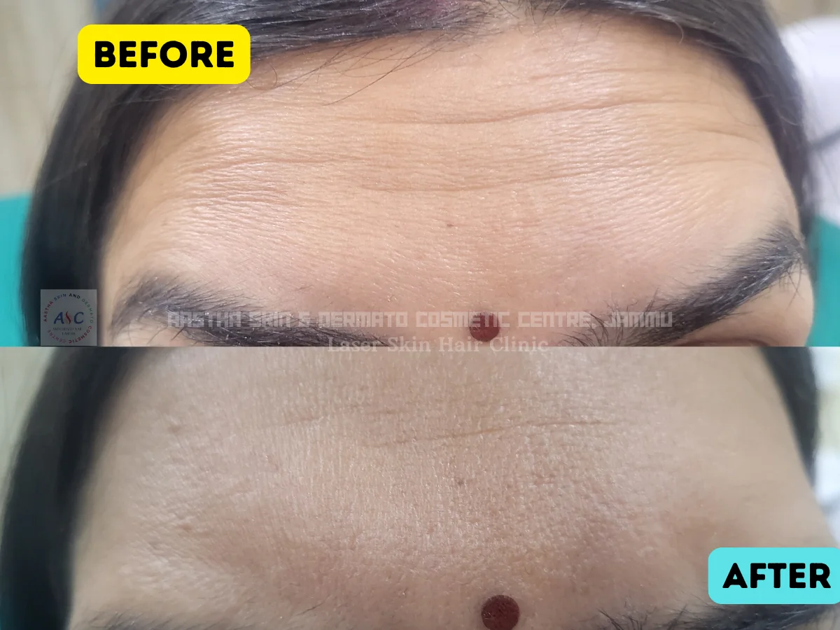 Clinic-supplied before-and-after photograph for botulinum toxin and dermal filler treatment (4 of 9).