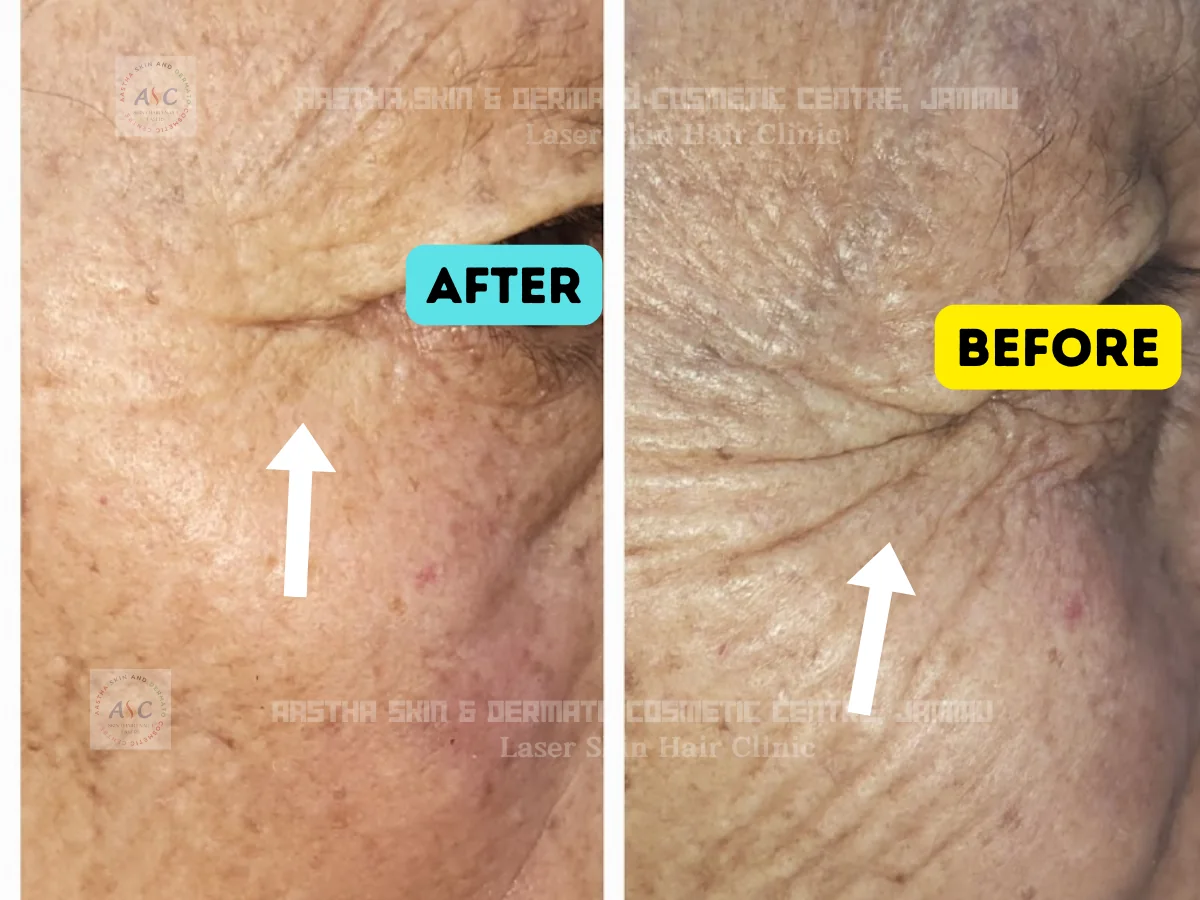 Clinic-supplied before-and-after photograph for botulinum toxin and dermal filler treatment (5 of 9).