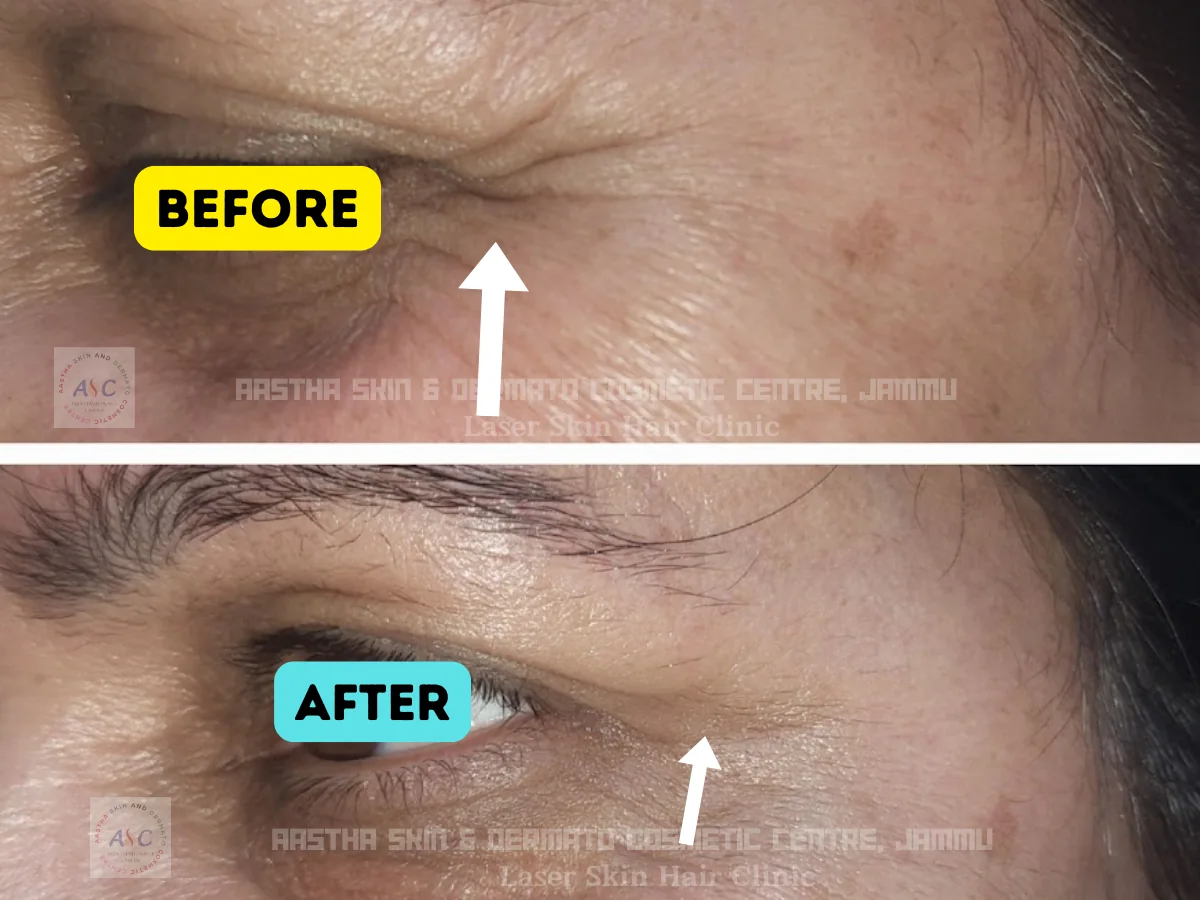 Clinic-supplied before-and-after photograph for botulinum toxin and dermal filler treatment (6 of 9).