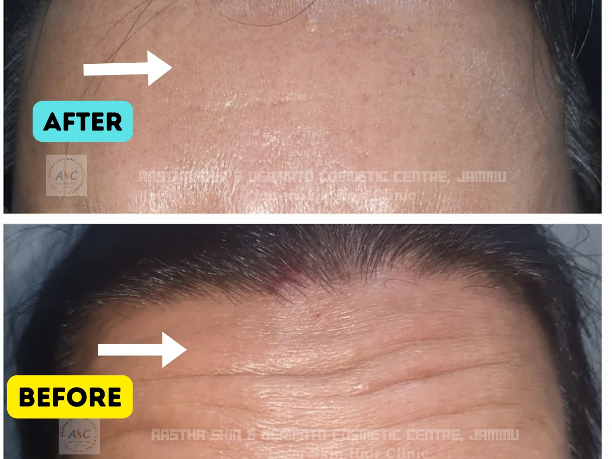 Clinic-supplied before-and-after photograph for botulinum toxin and dermal filler treatment (7 of 9).