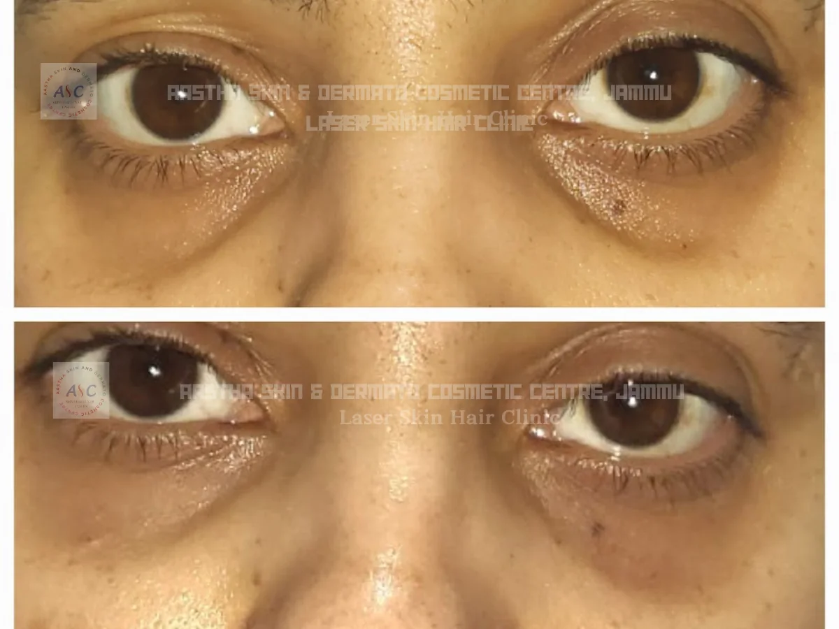 Clinic-supplied before-and-after photograph for botulinum toxin and dermal filler treatment (8 of 9).