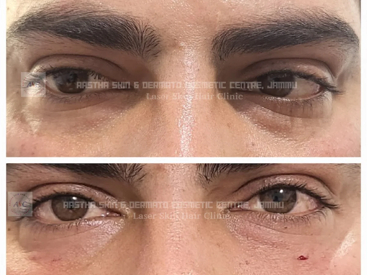Clinic-supplied before-and-after photograph for botulinum toxin and dermal filler treatment (9 of 9).