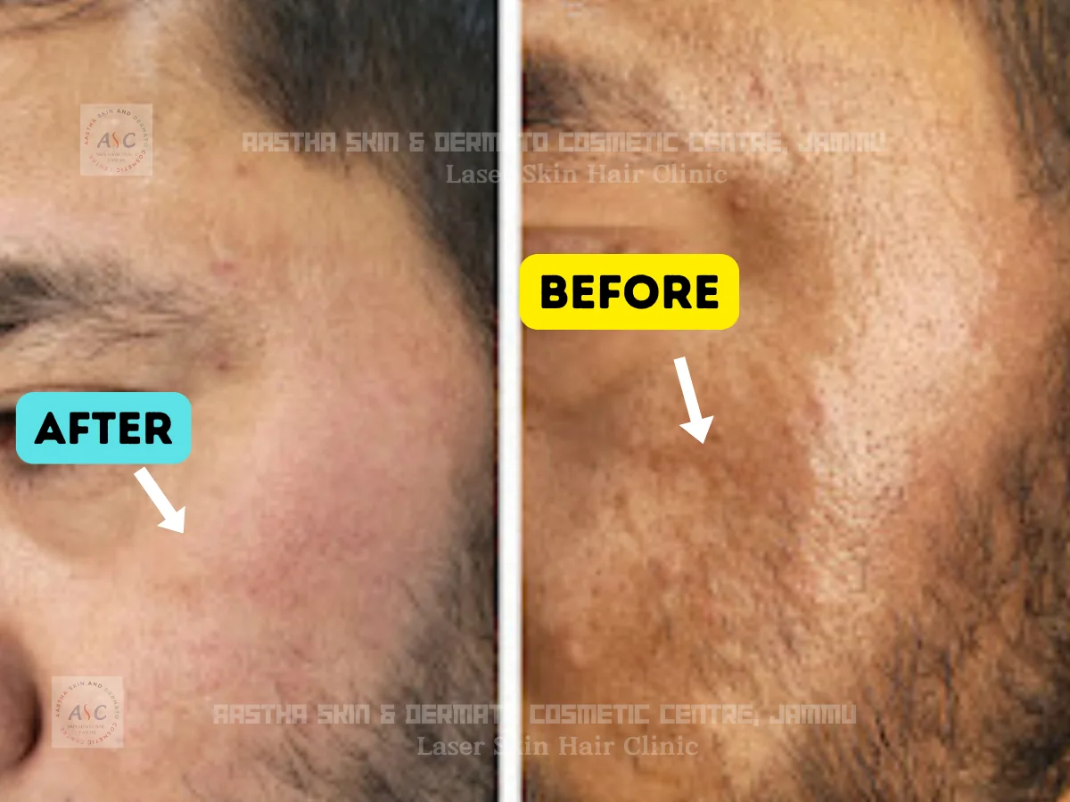 Clinic-supplied before-and-after photograph for chemical peel treatment (1 of 1).