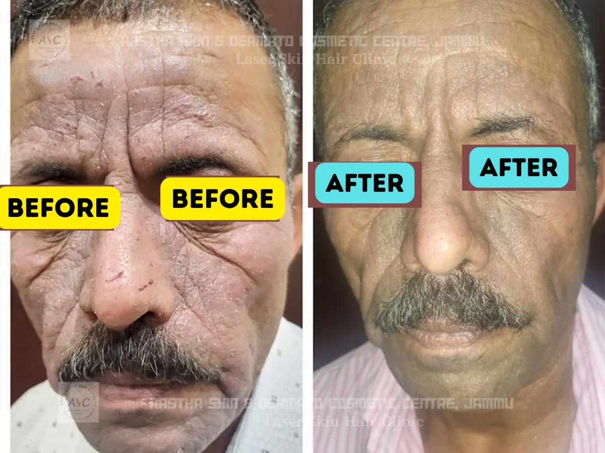 Clinic-supplied before-and-after photograph for contact dermatitis treatment (1 of 1).