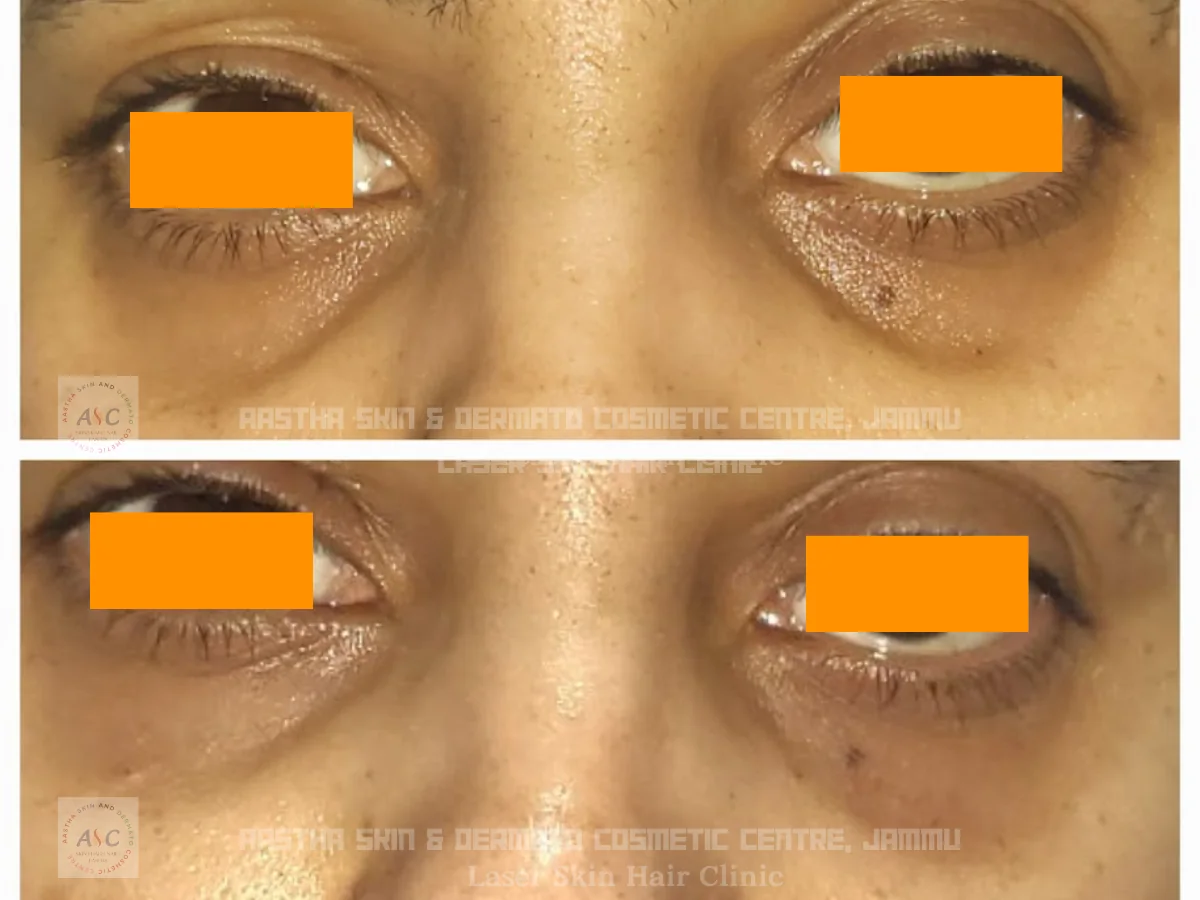Clinic-supplied before-and-after photograph for dark-circle treatment (1 of 1).
