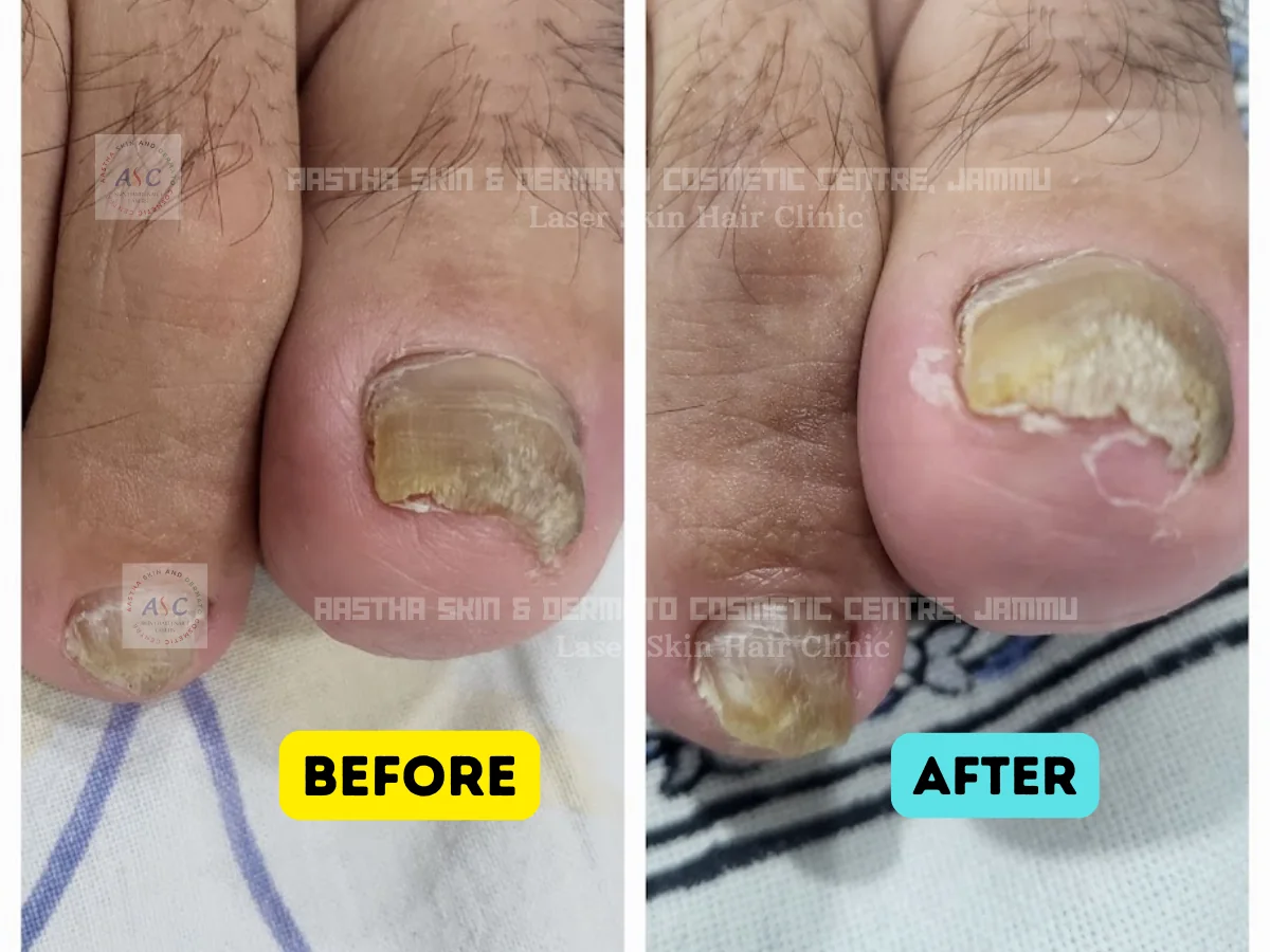 Clinic-supplied before-and-after photograph for fungal infection treatment (1 of 1).