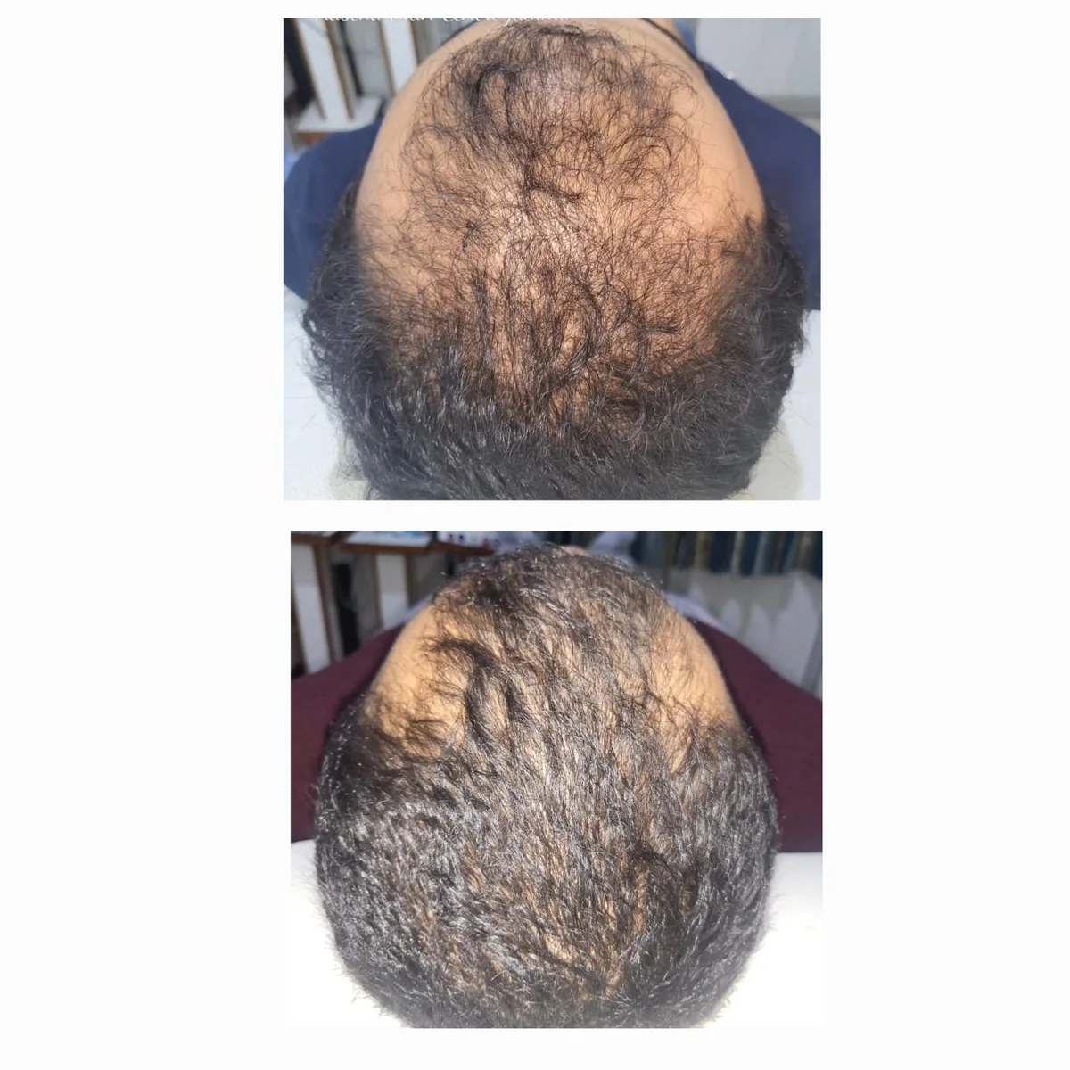 Clinic-supplied before-and-after photograph for hair-fall treatment (1 of 6).