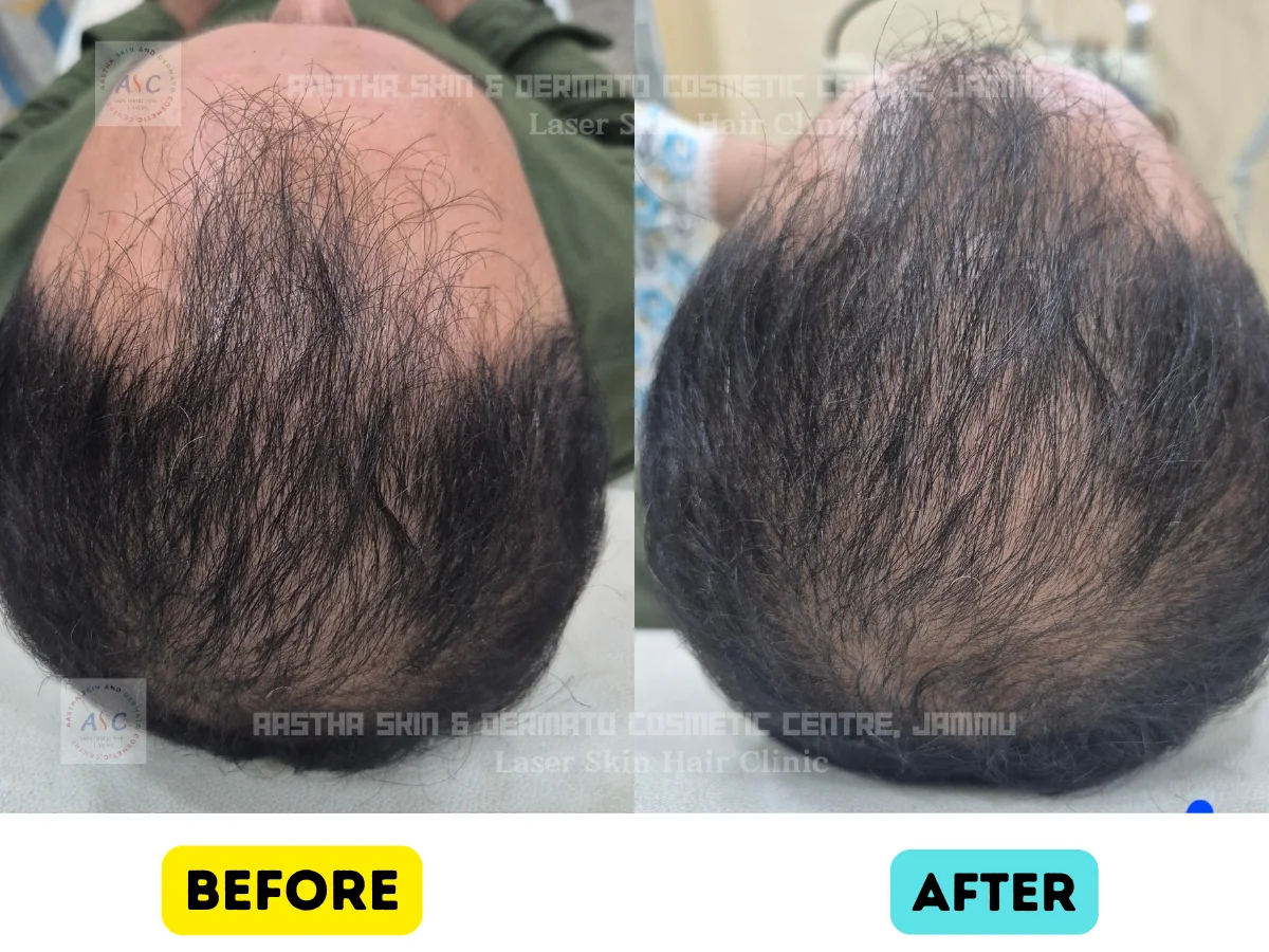 Clinic-supplied before-and-after photograph for hair-fall treatment (2 of 6).