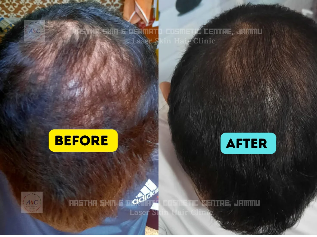 Clinic-supplied before-and-after photograph for hair-fall treatment (3 of 6).