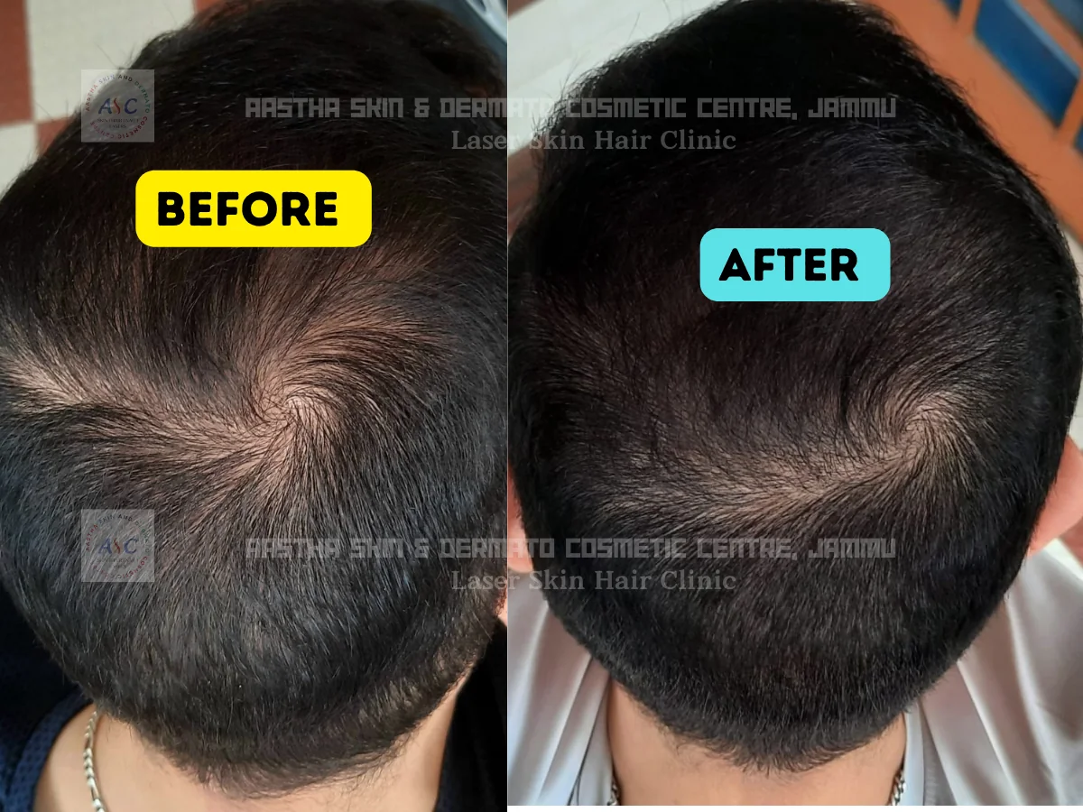 Clinic-supplied before-and-after photograph for hair-fall treatment (4 of 6).