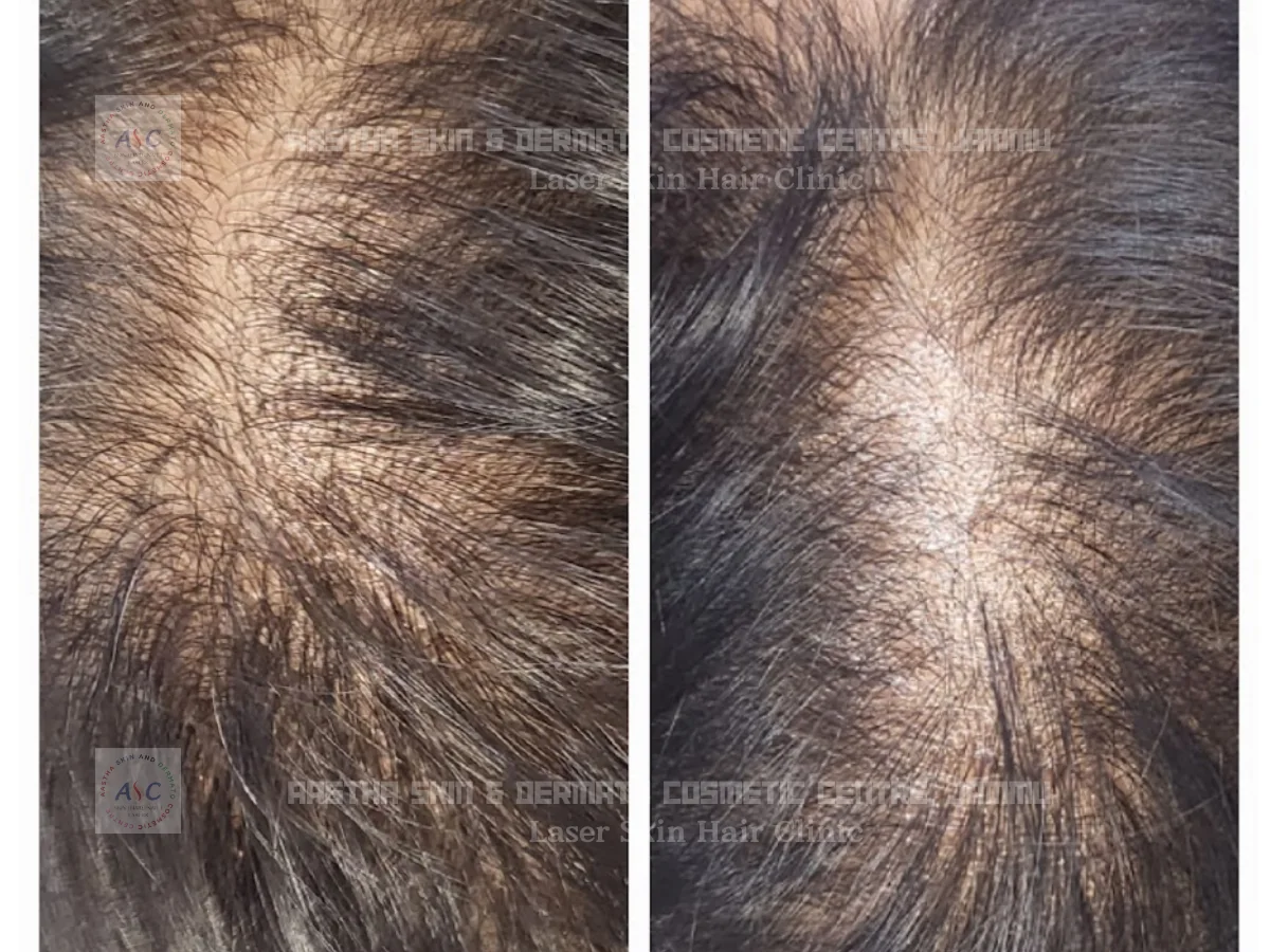 Clinic-supplied before-and-after photograph for hair-fall treatment (5 of 6).