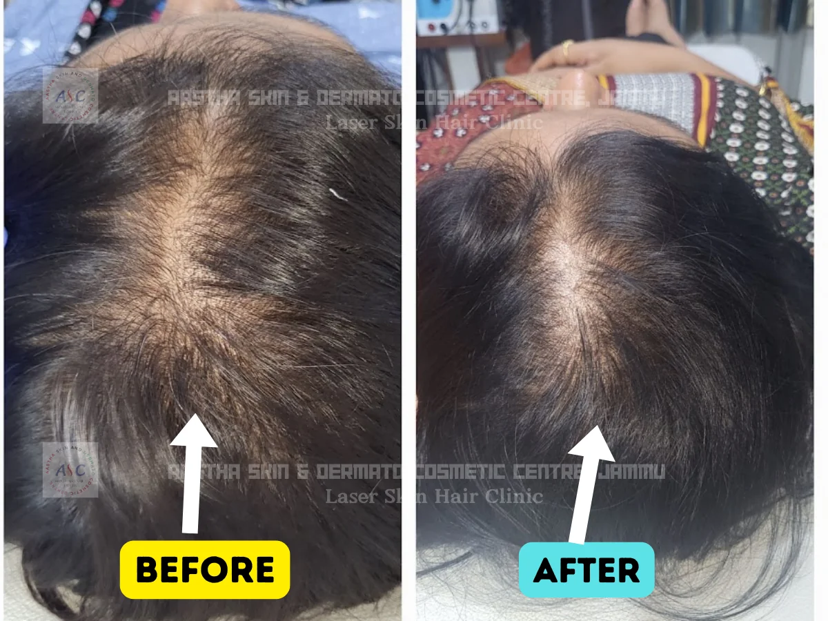 Clinic-supplied before-and-after photograph for hair-fall treatment (6 of 6).