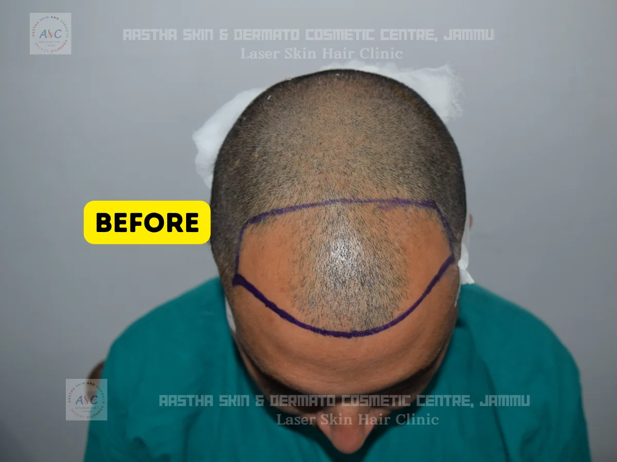 Clinic-supplied before-and-after photograph for hair transplant (1 of 2).