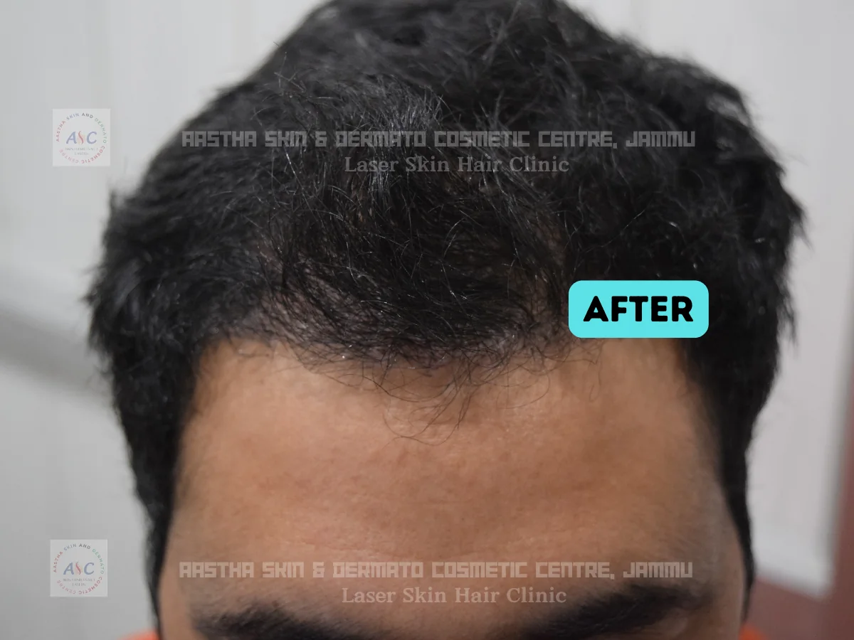 Clinic-supplied before-and-after photograph for hair transplant (2 of 2).