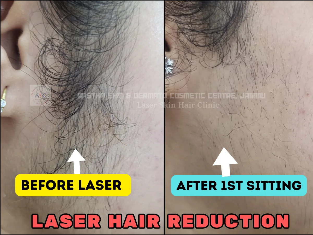 Clinic-supplied before-and-after photograph for laser hair reduction (1 of 7).