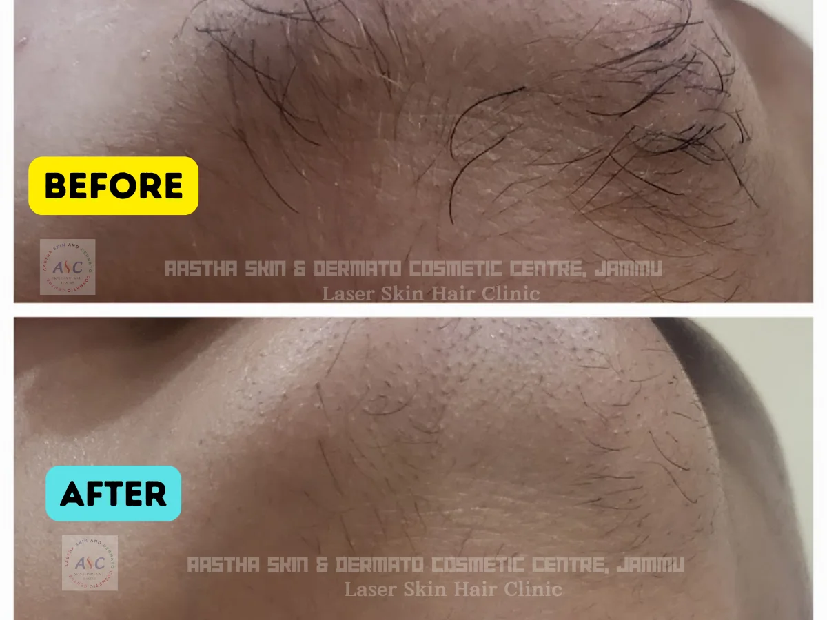 Clinic-supplied before-and-after photograph for laser hair reduction (2 of 7).