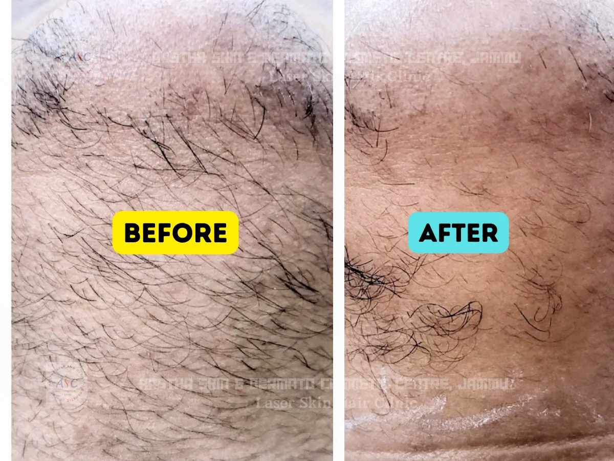 Clinic-supplied before-and-after photograph for laser hair reduction (3 of 7).
