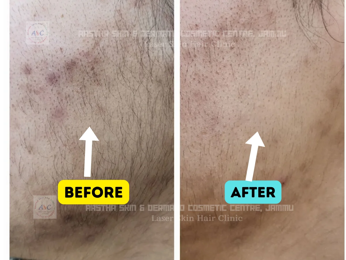 Clinic-supplied before-and-after photograph for laser hair reduction (4 of 7).