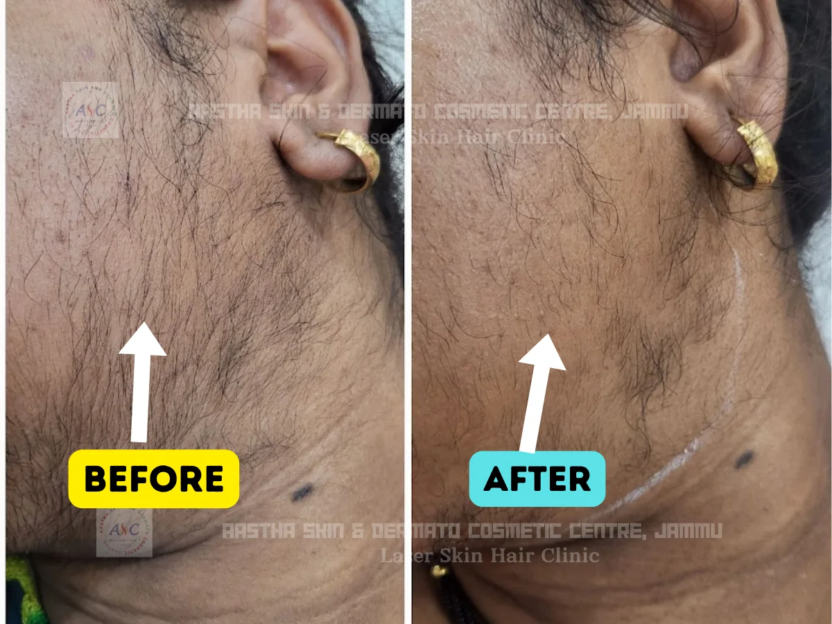 Clinic-supplied before-and-after photograph for laser hair reduction (5 of 7).