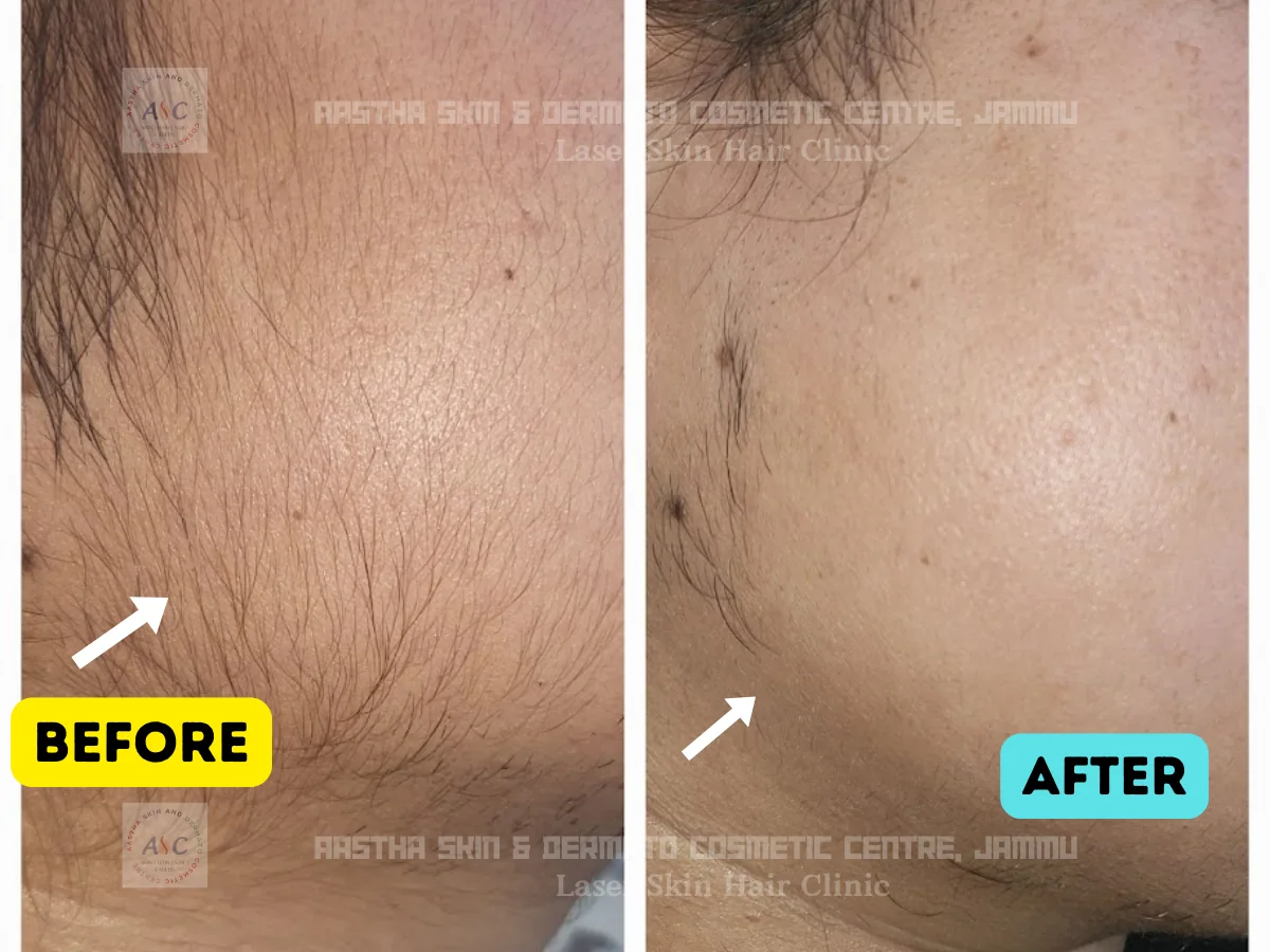 Clinic-supplied before-and-after photograph for laser hair reduction (6 of 7).