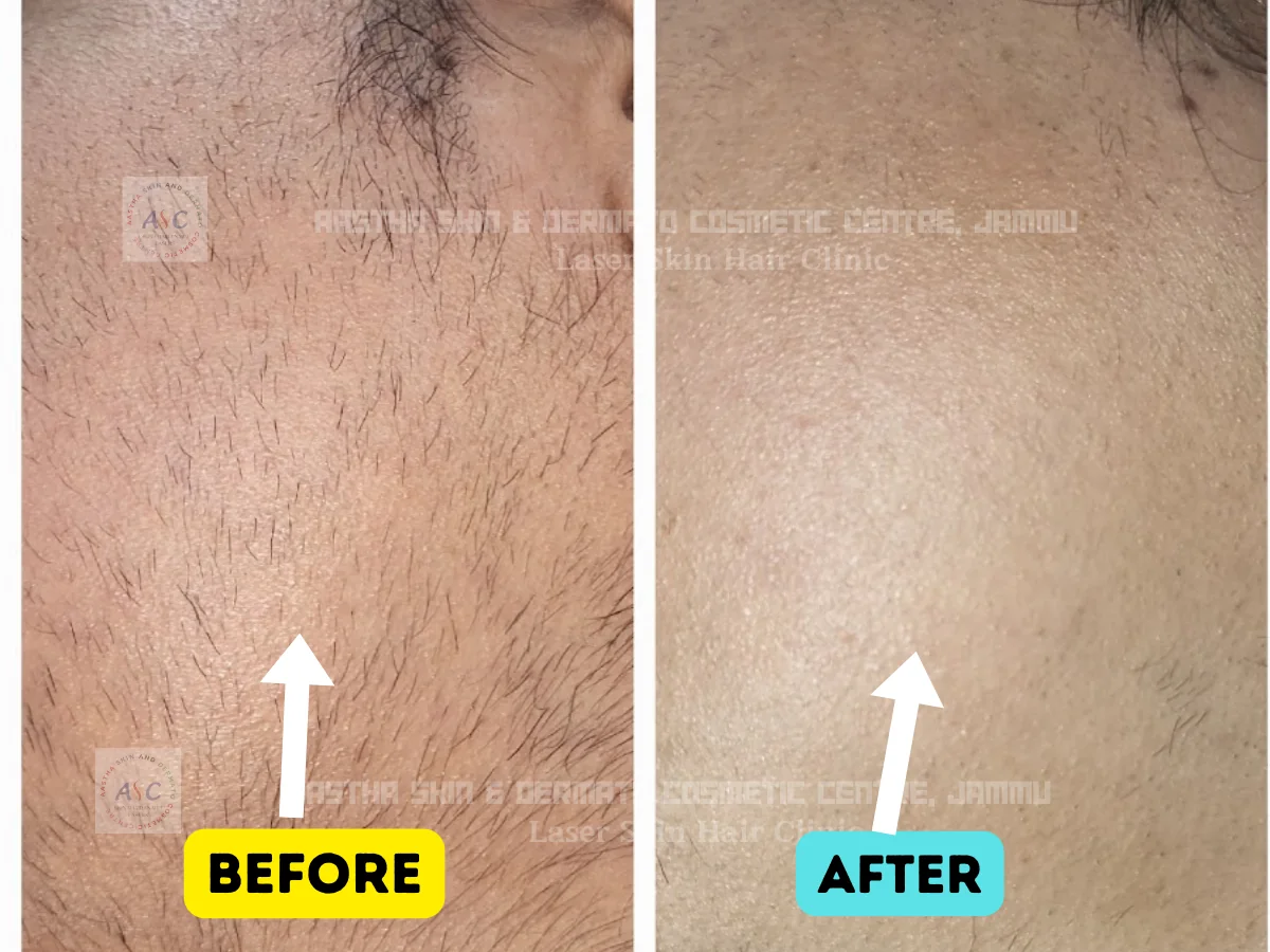 Clinic-supplied before-and-after photograph for laser hair reduction (7 of 7).