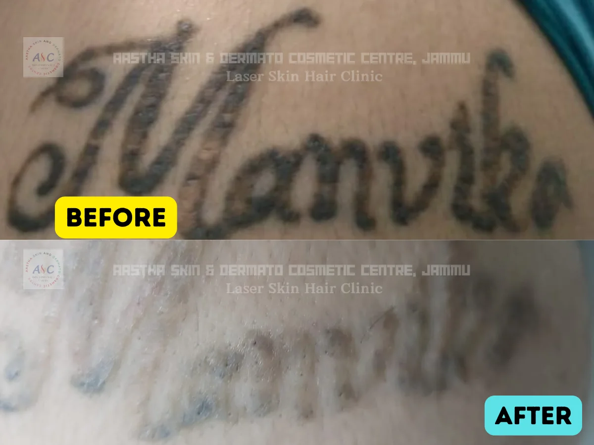 Clinic-supplied before-and-after photograph for laser tattoo removal (1 of 1).