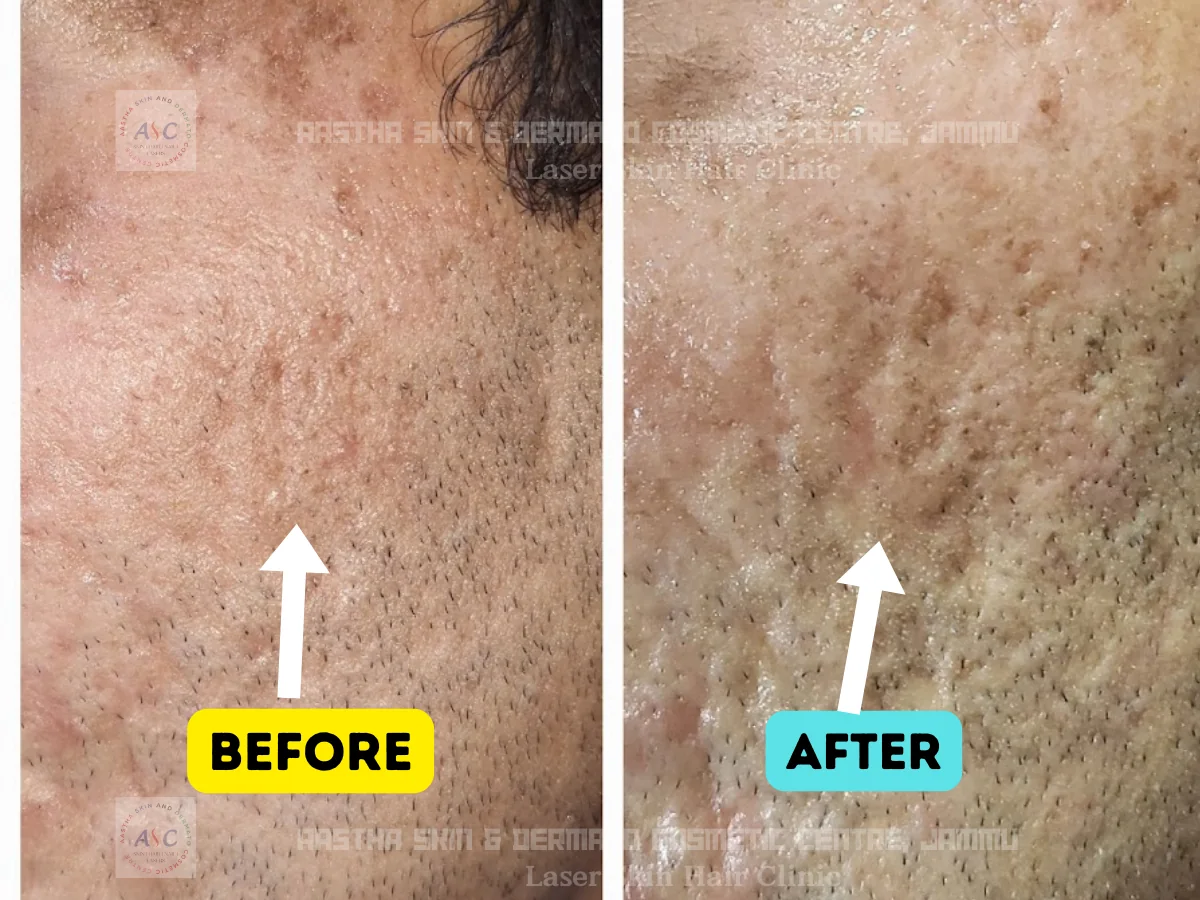 Clinic-supplied before-and-after photograph for microneedling radiofrequency treatment (2 of 3).