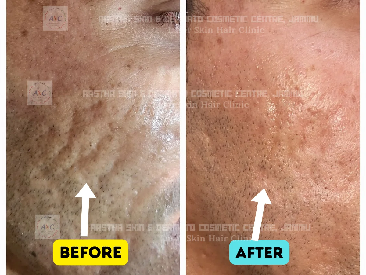 Clinic-supplied before-and-after photograph for microneedling radiofrequency treatment (3 of 3).