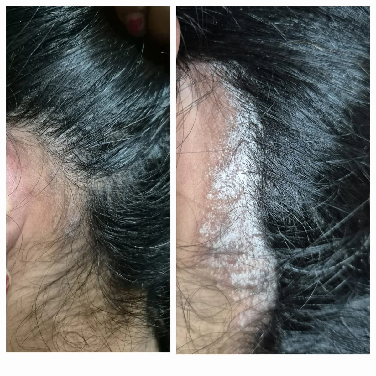 Clinic-supplied before-and-after photograph for psoriasis treatment (1 of 1).