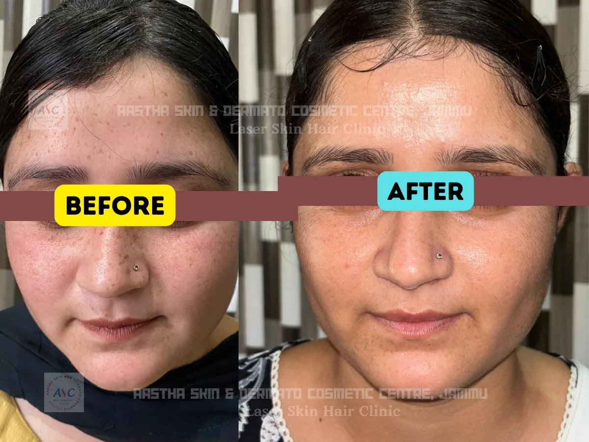 Clinic-supplied before-and-after photograph for q-switched laser and laser toning (1 of 4).