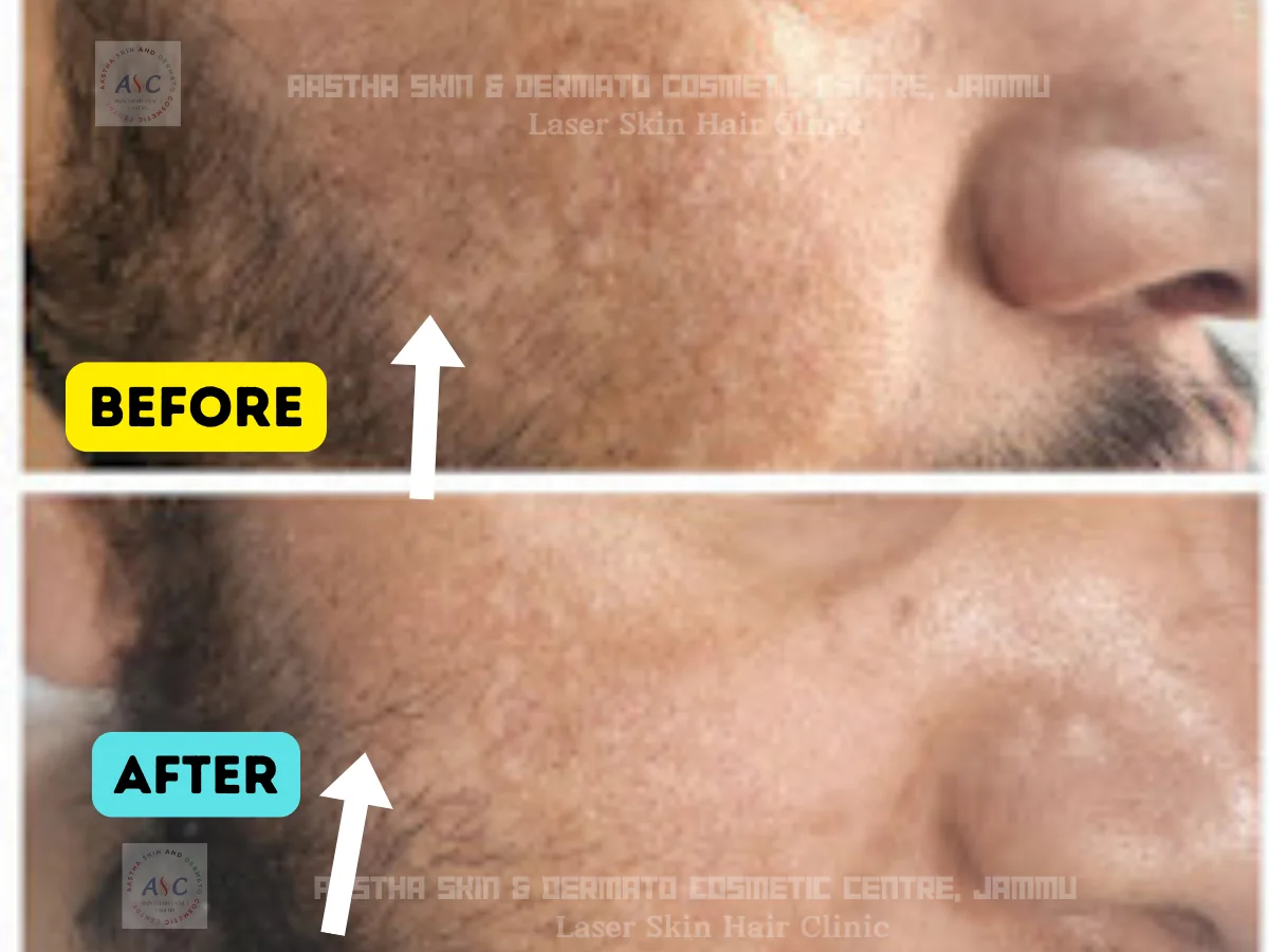 Clinic-supplied before-and-after photograph for q-switched laser and laser toning (2 of 4).