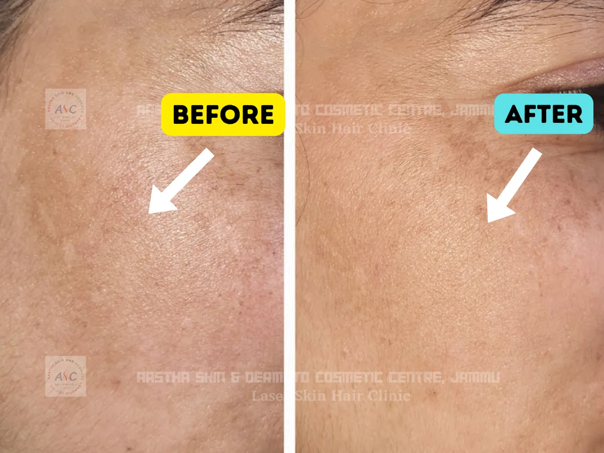 Clinic-supplied before-and-after photograph for q-switched laser and laser toning (3 of 4).