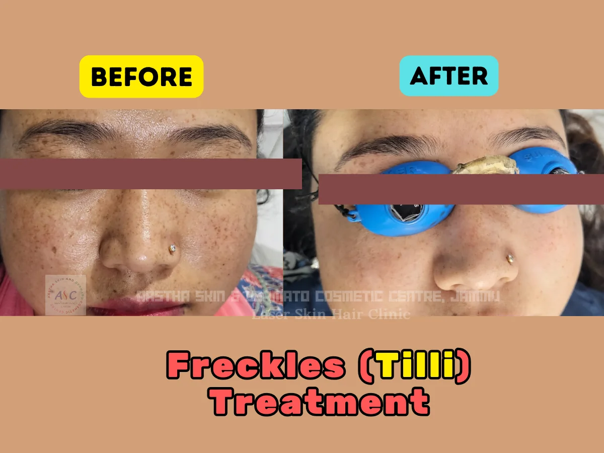 Clinic-supplied before-and-after photograph for q-switched laser and laser toning (4 of 4).