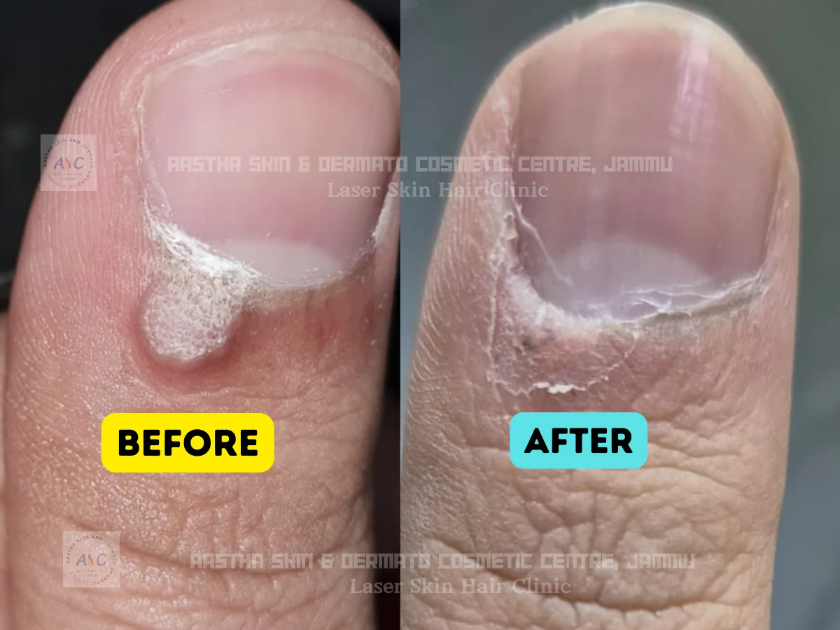 Clinic-supplied before-and-after photograph for wart treatment (1 of 1).